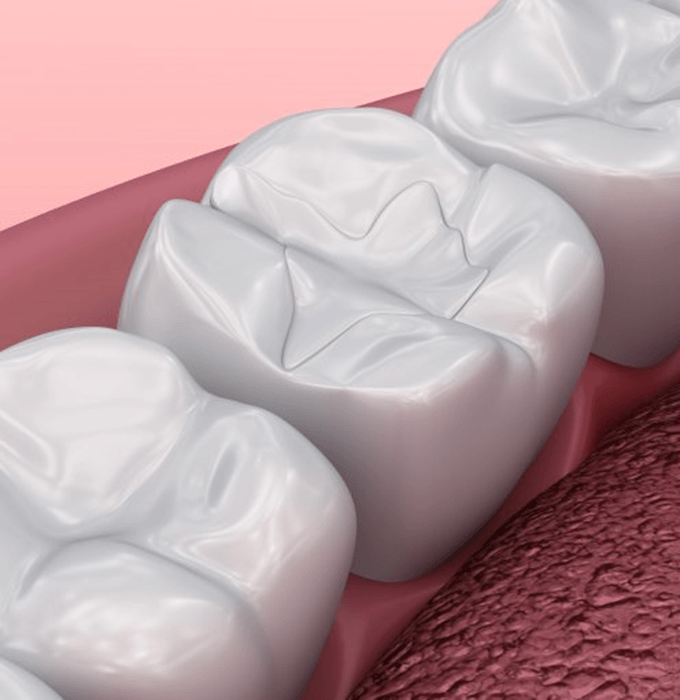 a 3D illustration of a tooth-colored filling