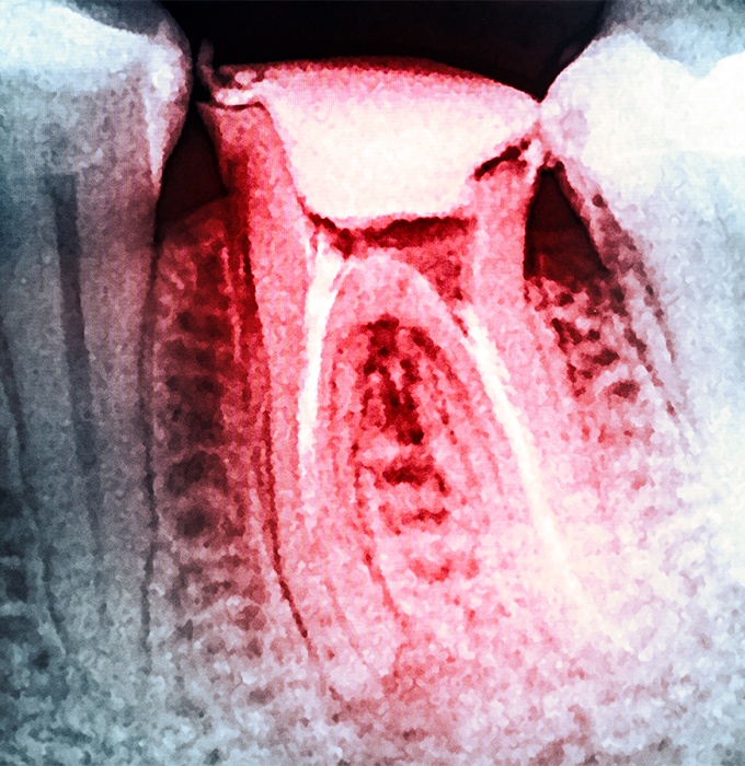X-ray of tooth after root canal therapy