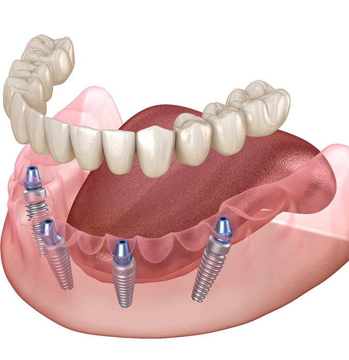 Illustration for All-on-4 in Lansing, MI in the lower jaw