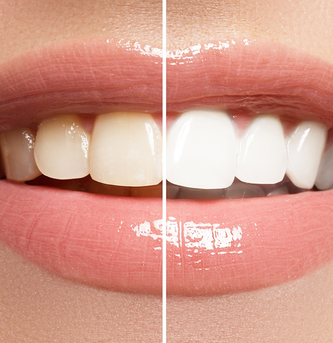 Smile before and after teeth whitening