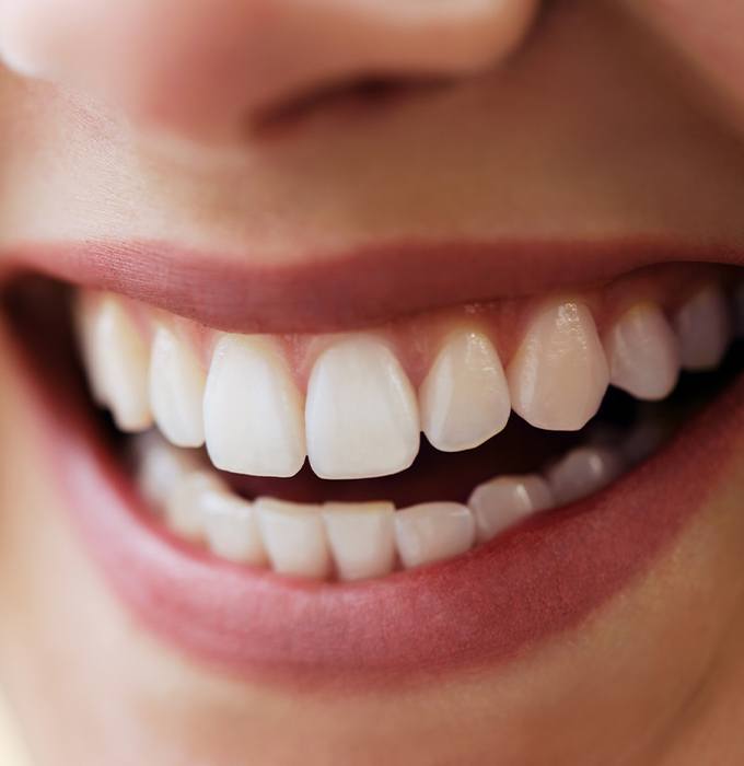 Closeup of smile after gum recontouring