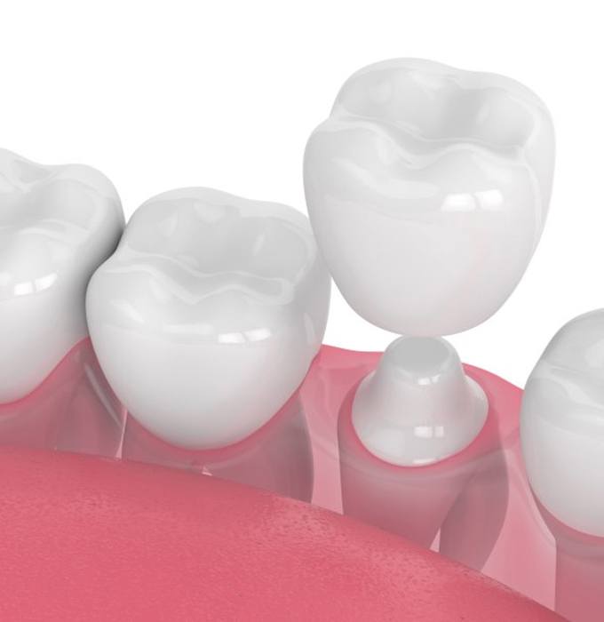 a 3 D digital illustration of a dental crown