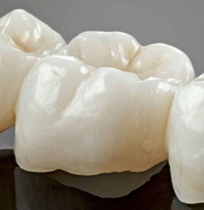 Dental Bridges