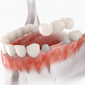 Traditional Dental Bridge