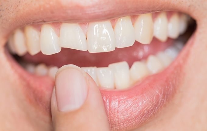 Closeup of smile with chipped tooth