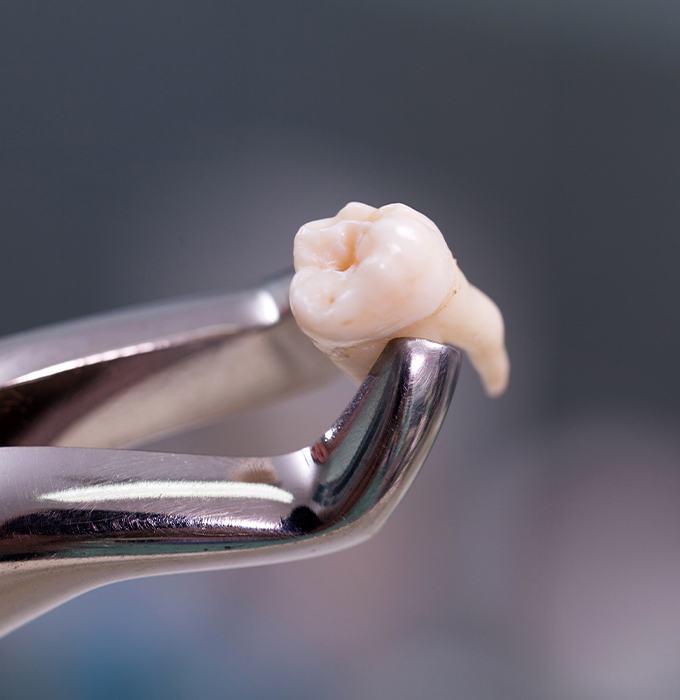 Metal clasp holding an extracted wisdom tooth