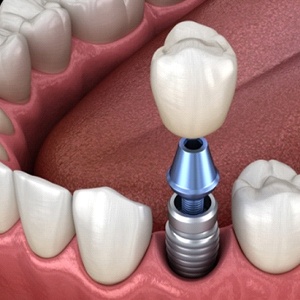3D illustration of a single dental implant in lower arch