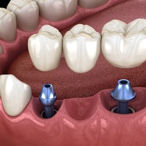 3D illustration of an implant bridge in lower arch