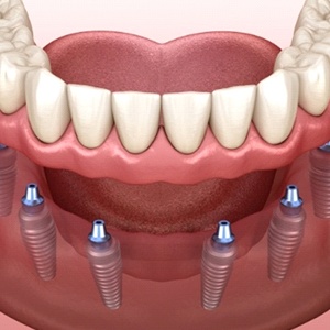 3D illustration of lower implant denture