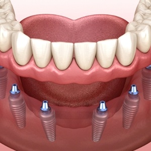 Implant Bridge