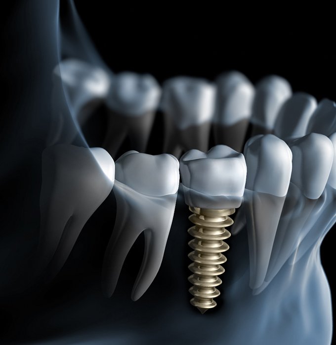 X-ray illustration of jaw after dental implant salvage in Lansing 