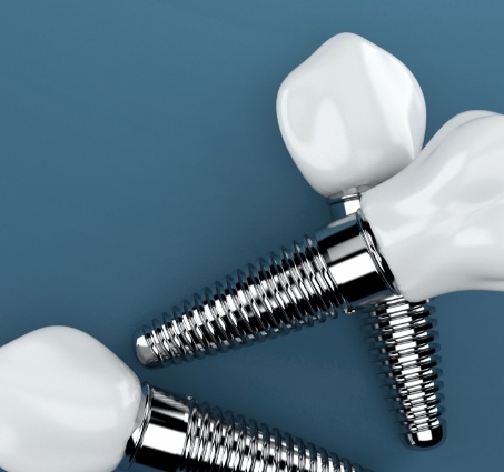 Three animated dental implant supported dental crowns