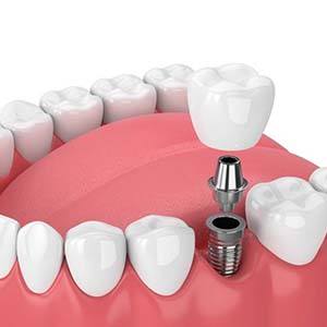 3D illustration of a dental implant in the lower arch of the smile
