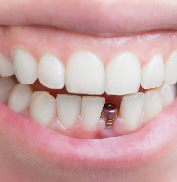 Smile with dental implant post visible in socket