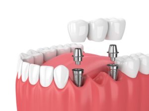 dental implants illustration