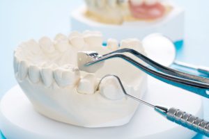 White model of a tooth on a set of lower teeth being fitted with a dental crown using small metal instruments